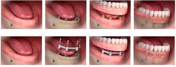 Имплантирование зубов 'Все на 4'