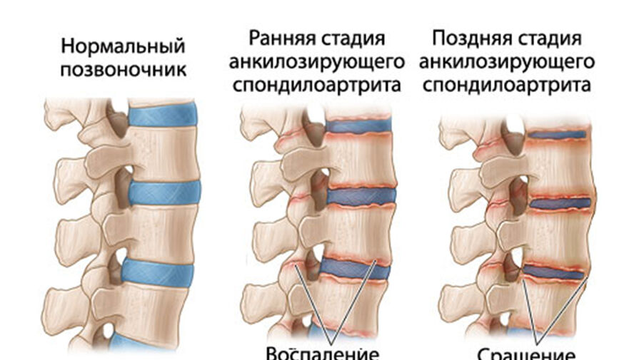 Сибирские ученые создадут тест-системы для ранней диагностики заболевания позвоночника